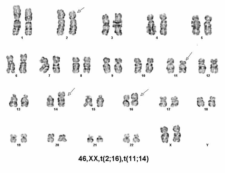 A representative karyotype and metaphase cell shows 46,XX,t(2;16)(p21;p11.2),t(11;14)(p13;p11.2). The arrows indicate translocations between chromosomes 2p21 and 16p11.2, and between 11p13 and 14p11.2, respectively.